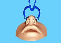Nose Clip - Sands Canada